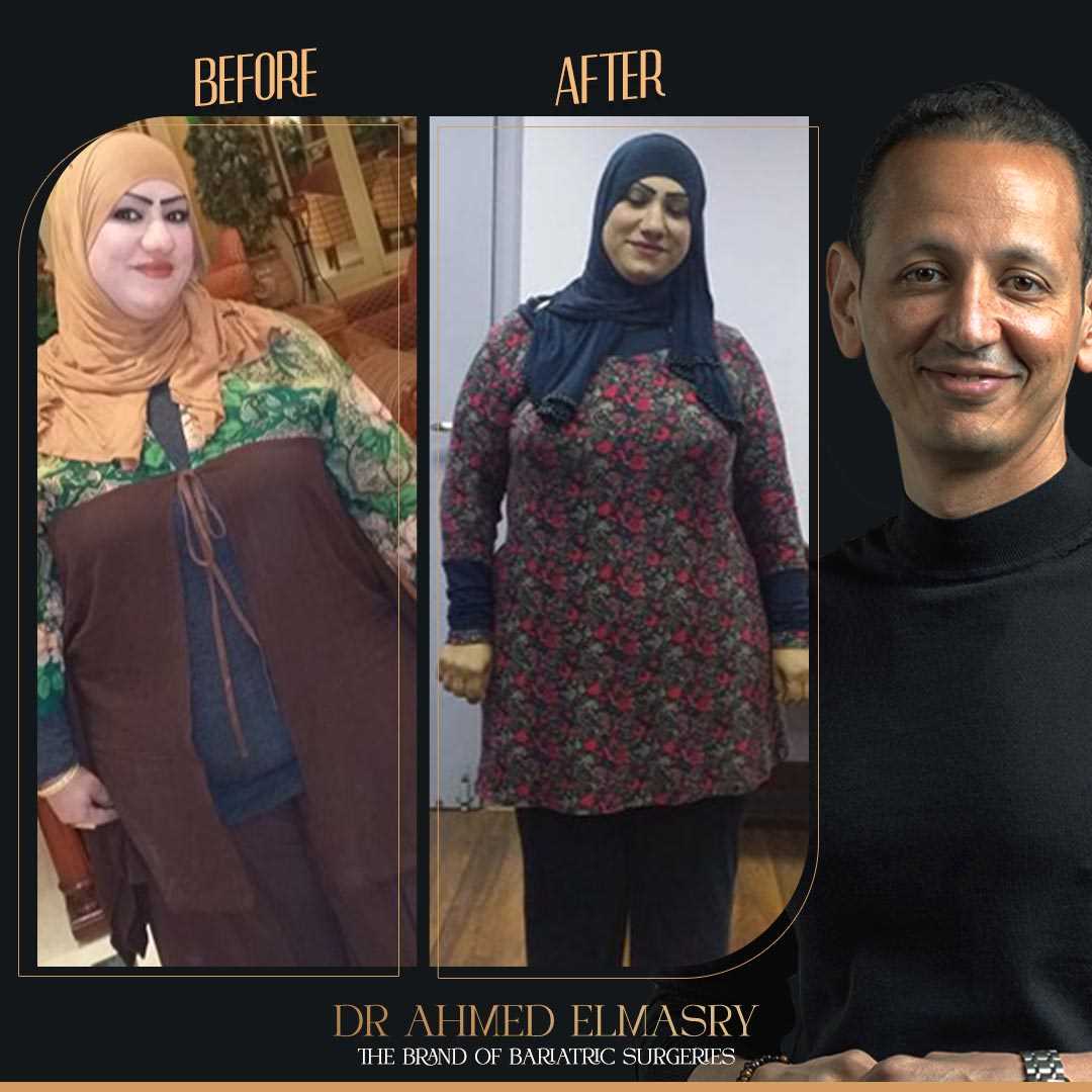 From 127 to 80 Kilos in one year..And the secret is Gastric Sleeves!